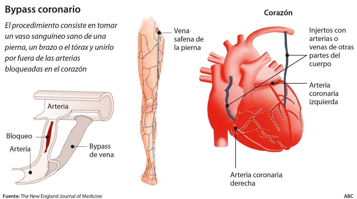 baipas-corazon-rey--620x349-kkBC--1248x698@abc.jpg.webp