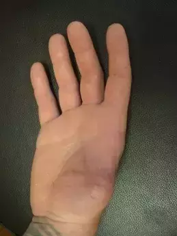 Screenshot 2024-03-19 at 10-33-46 hands without thumbs - Buscar con Google.png