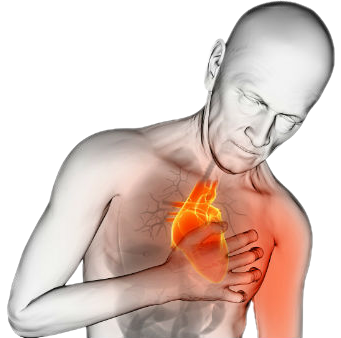 Infarto-de-Miocardio.png